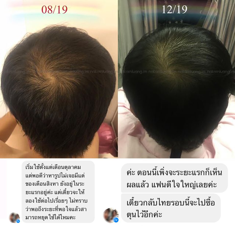 รีวิว คนไข้รักษาผมร่วง จากคลินิกนครหลวงการแพทย์